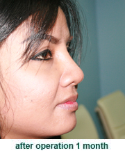 plastic_surgery_augmentation_rhinoplasty